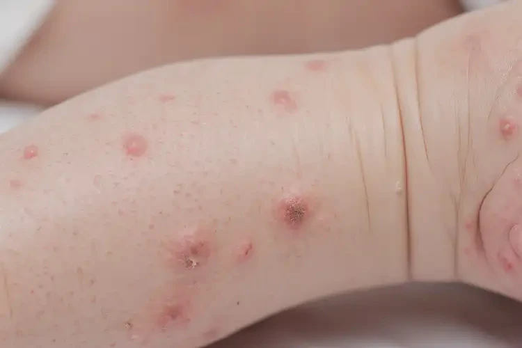 孩子小腿長濕疹可不可以根治(圖4)