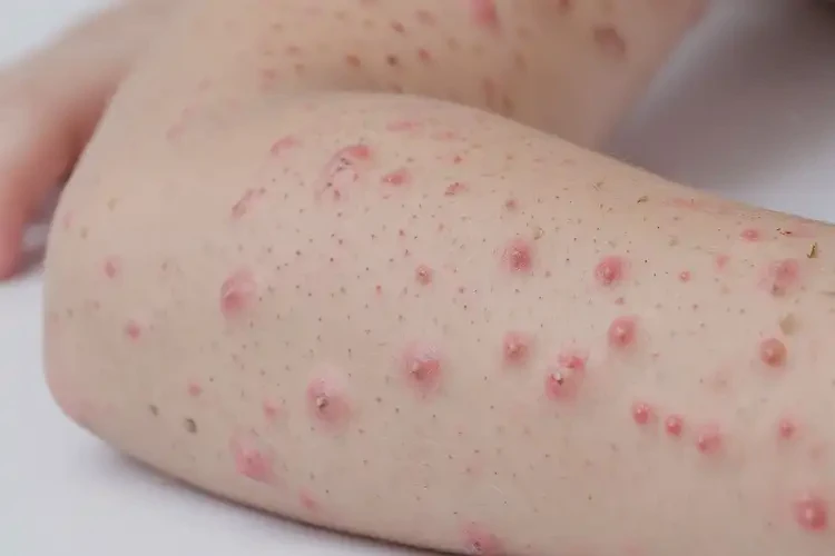 小孩手臂上經(jīng)常長濕疹可以治好嗎(圖4)