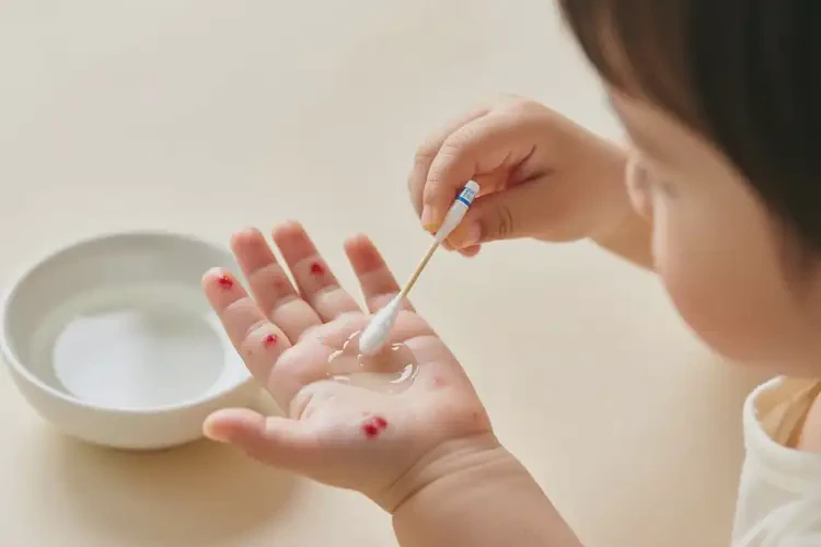 幼兒手上有濕疹可不可以根治(圖2)