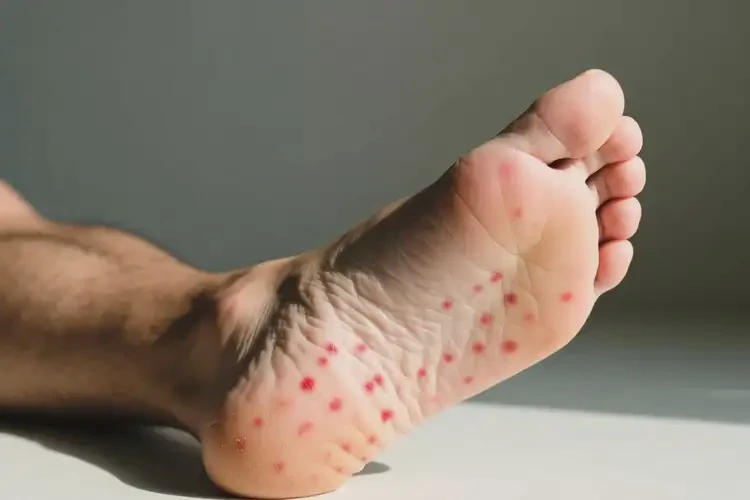 男性脚上偶尔长湿疹可不可以根治(图1)