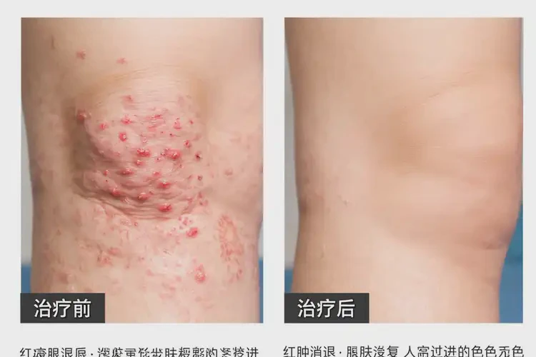 小孩小腿上長濕疹可以治好嗎(圖4)