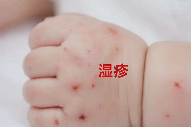 寶寶手上出濕疹可以治好嗎(圖4)
