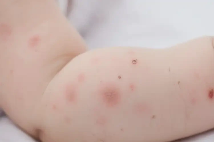 嬰幼兒手臂上偶爾長濕疹可以治好嗎(圖4)