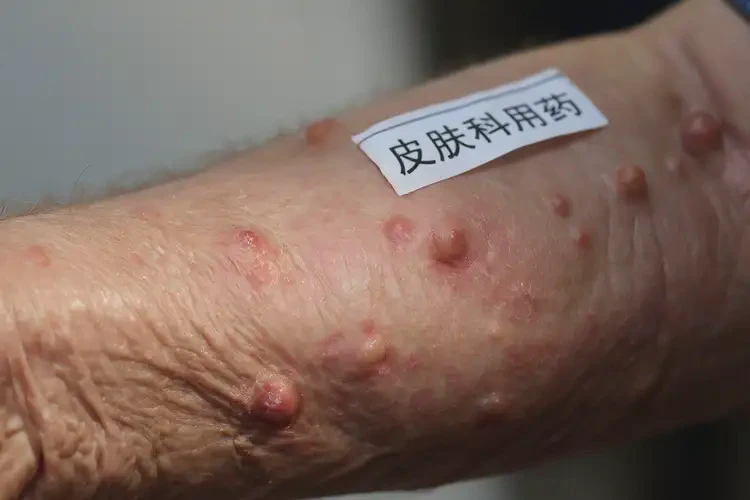 高齡老人手臂上出濕疹可不可以根治(圖4)