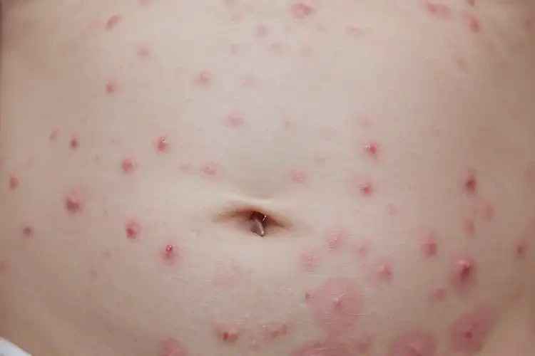 新生儿肚子上偶尔长湿疹可不可以根治(图4)