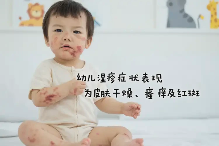 幼兒全身有濕疹可不可以根治(圖4)
