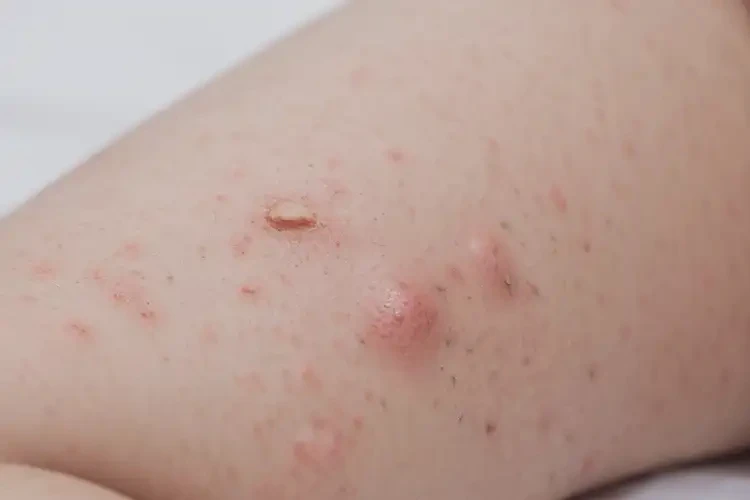 嬰幼兒大腿上長濕疹可以治好嗎(圖4)