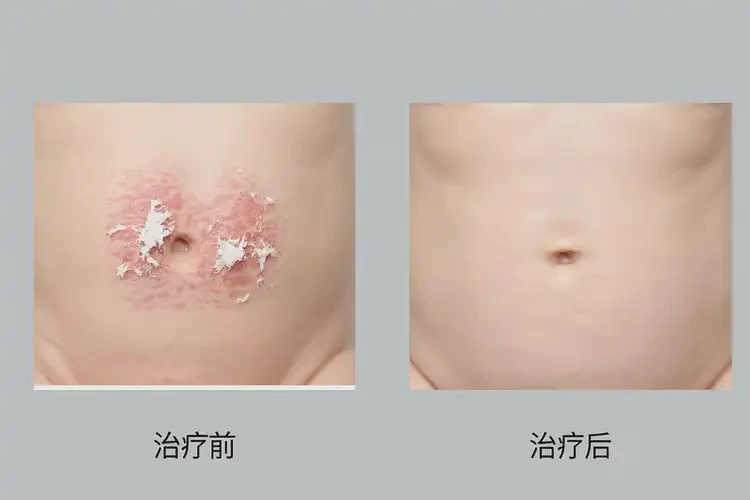 新生兒肚子上長濕疹可不可以根治(圖1)