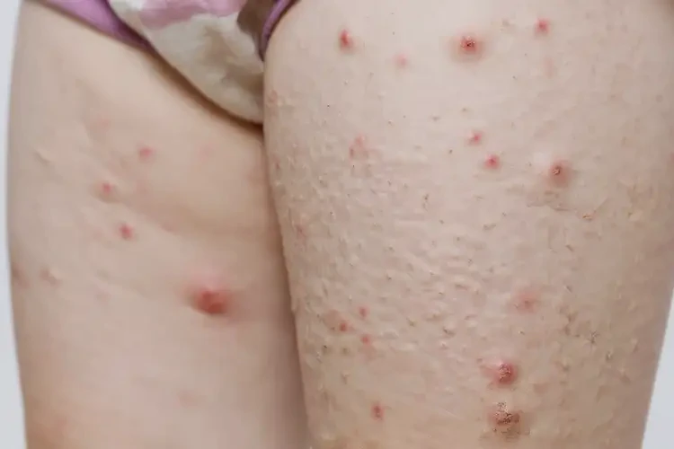 兒童大腿容易長(zhǎng)濕疹可以治好嗎(圖4)