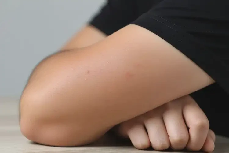 男性手臂上容易長濕疹可不可以根治(圖1)