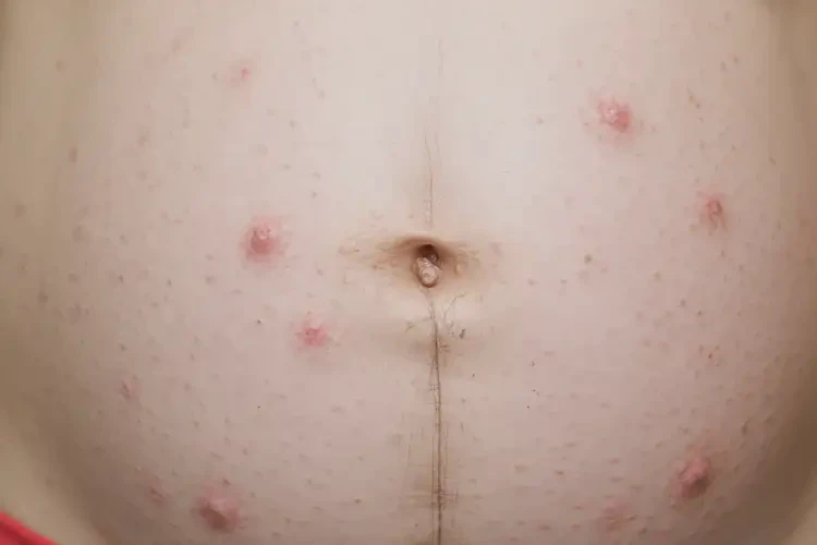 孕妇肚子上偶尔起湿疹不管它会自己自愈吗(图4)