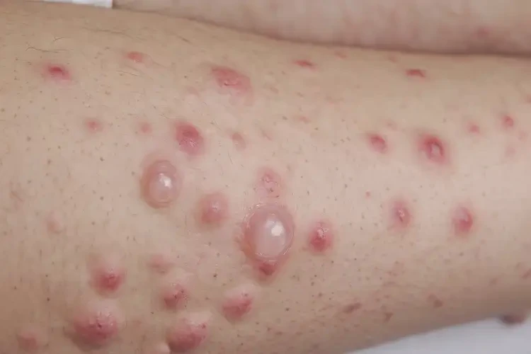 女性四肢经常长湿疹可以治好吗(图4)