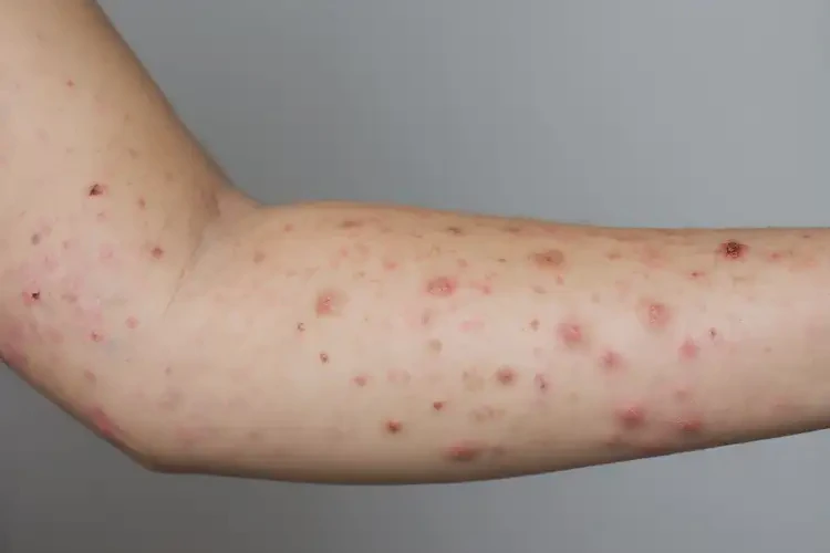 女生手臂出現(xiàn)濕疹可不可以根治(圖4)