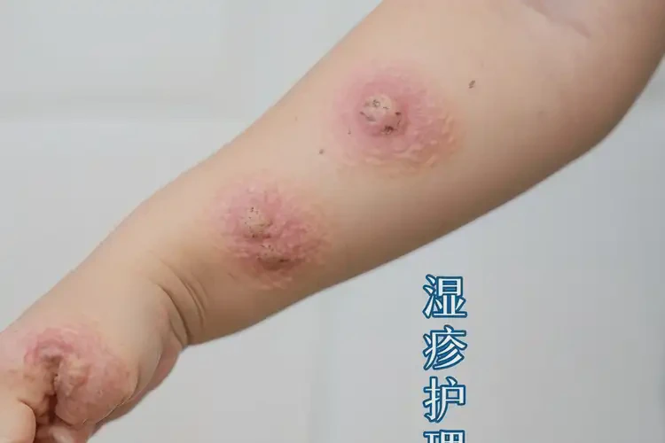 少兒手臂出現(xiàn)濕疹可以徹底自愈嗎(圖4)