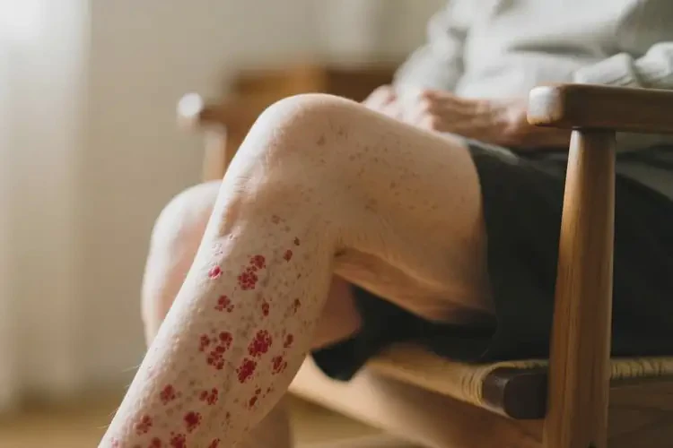 老人大腿上經常起濕疹可不可以根治(圖4)