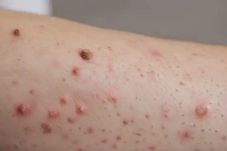 青少年手臂出濕疹能夠徹底治愈嗎(圖4)