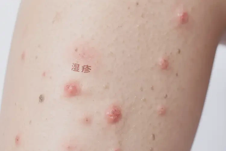 女性小腿上出濕疹可不可以根治(圖4)