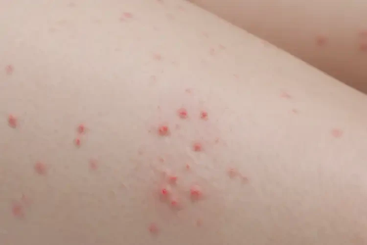 孩子大腿上有濕疹可以治好嗎(圖4)