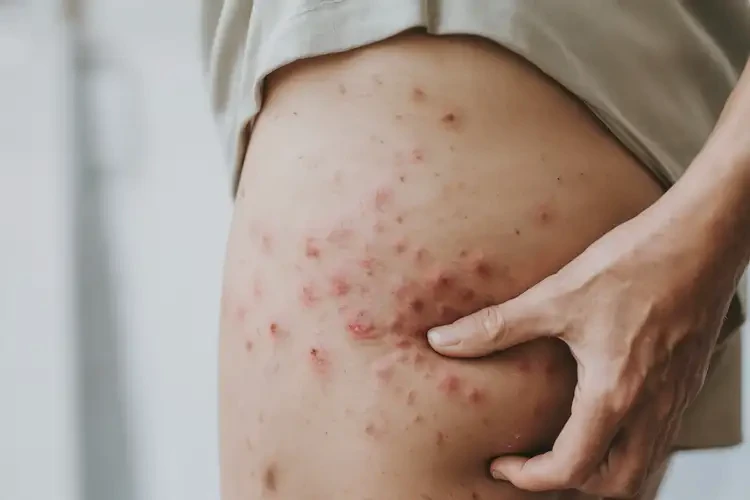 女性屁股出现湿疹可不可以根治(图4)