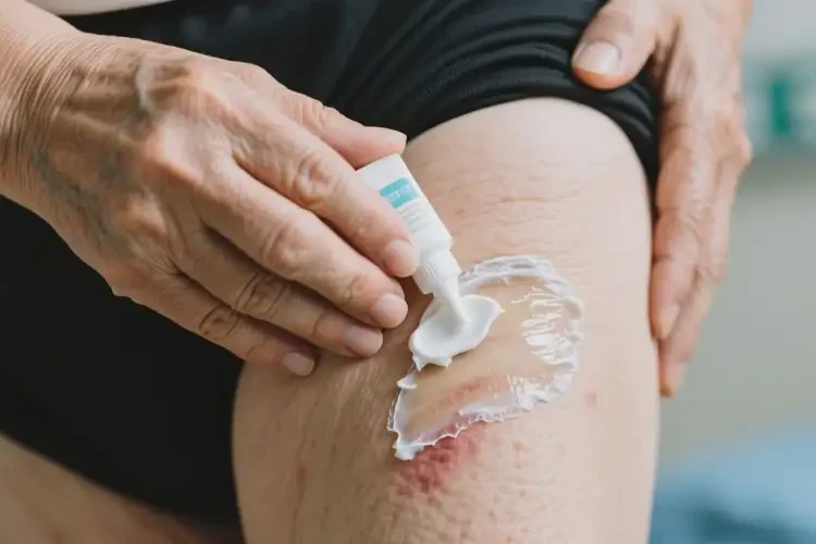 老年人屁股經(jīng)常長(zhǎng)濕疹可不可以根治(圖2)