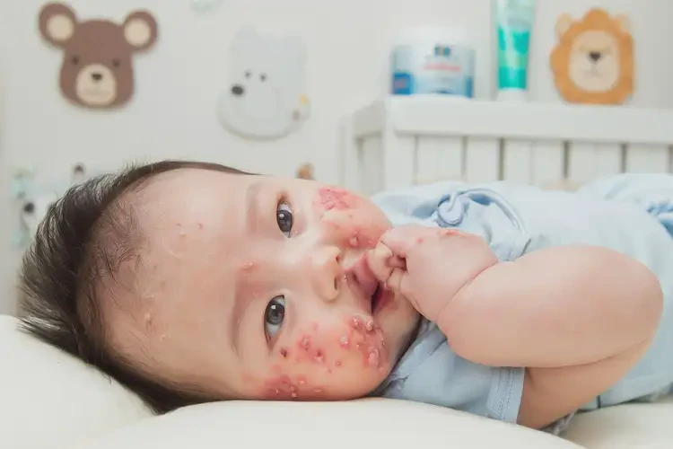 宝宝脸上经常长湿疹可以治好吗(图4)
