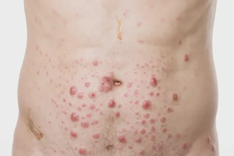 男性肚子长湿疹可以治好吗(图4)