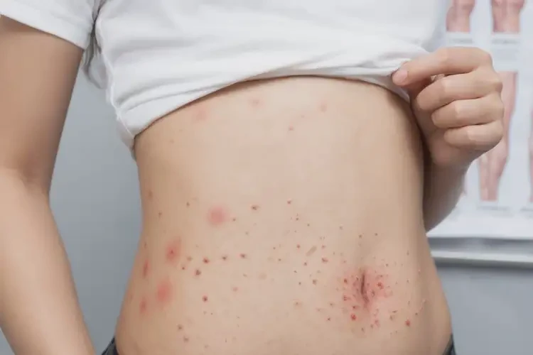 女人肚子出現(xiàn)濕疹能徹底自愈嗎(圖4)