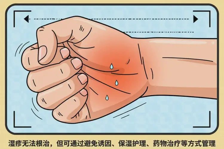 男生手上有濕疹可不可以根治(圖2)