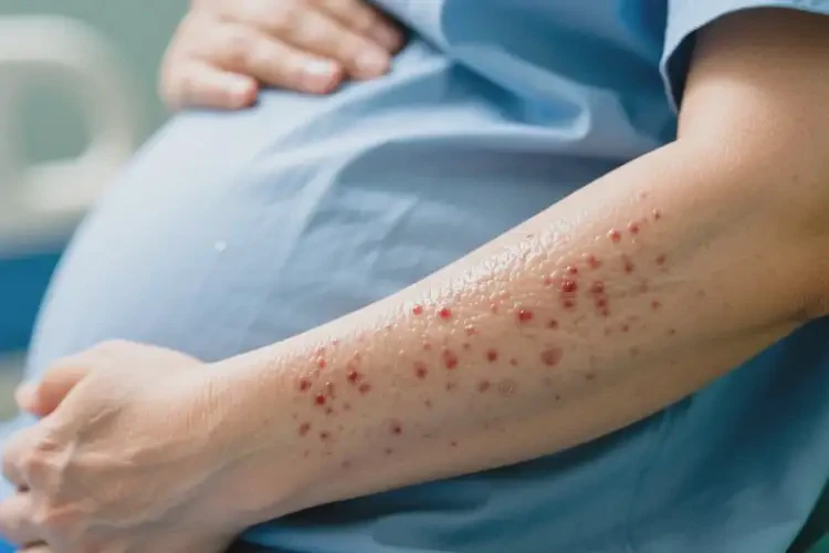 產(chǎn)婦手臂容易起濕疹可不可以根治(圖1)