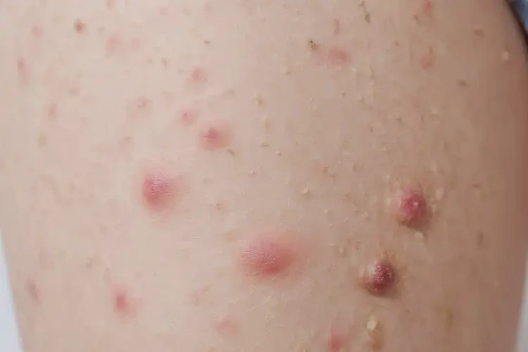 孩子大腿有濕疹能靠自己自愈嗎(圖4)