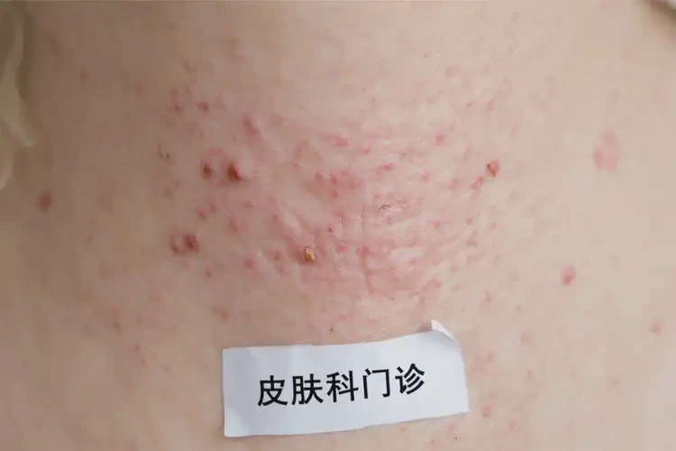 孕婦脖子上出濕疹可不可以根治(圖4)