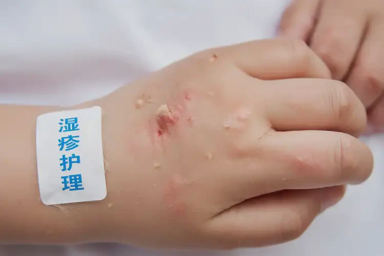 孩子手上偶爾起濕疹可不可以根治(圖4)