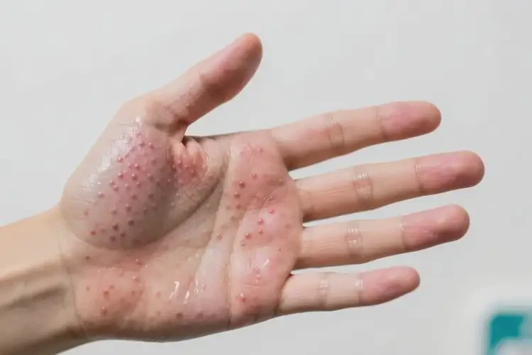 男生手上偶尔起湿疹可不可以根治(图4)