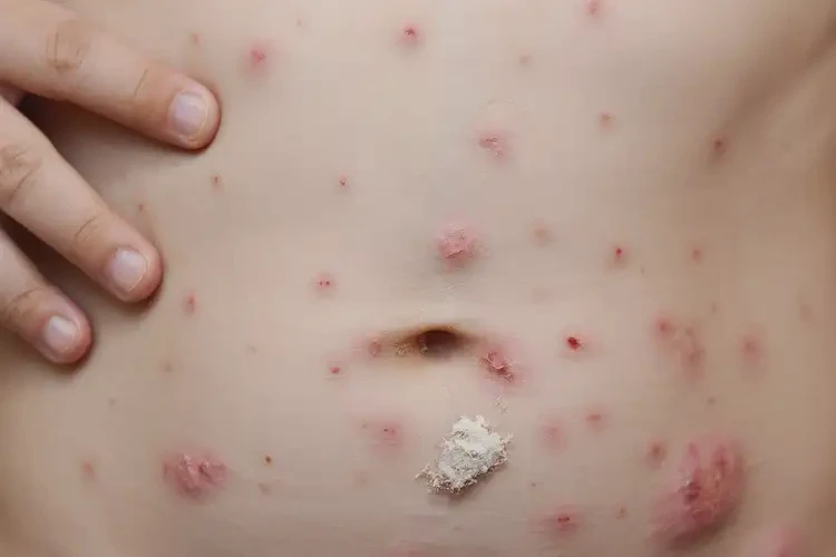 小學生肚子上容易起濕疹可不可以根治(圖4)