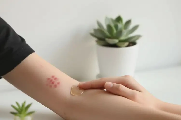 青少年手臂上容易起濕疹可不可以根治(圖3)