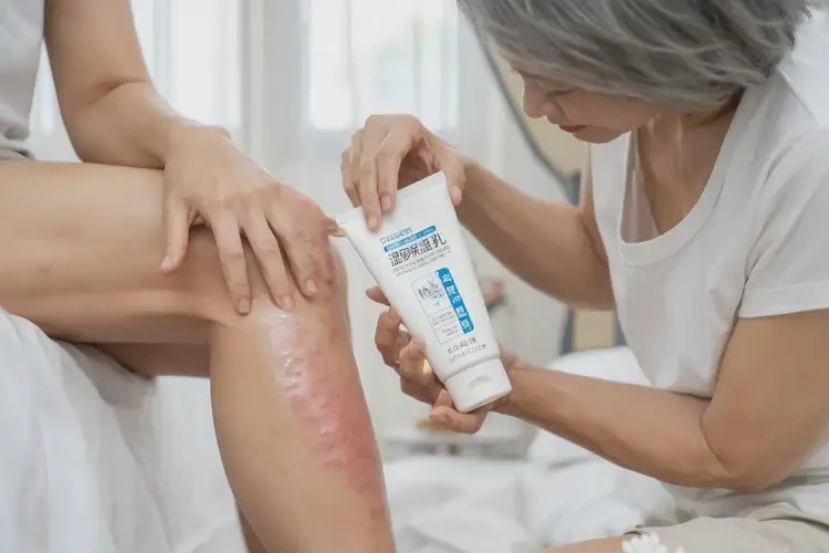 哺乳期媽媽大腿起濕疹可不可以徹底自愈(圖3)