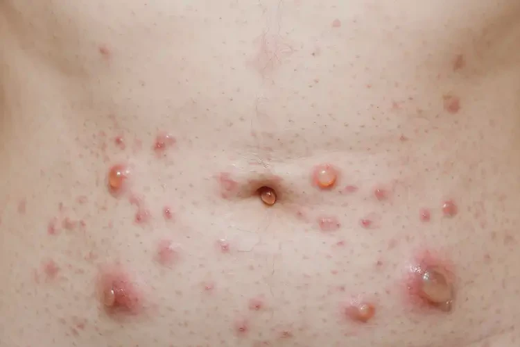 女性肚子偶爾起濕疹可不可以根治(圖4)