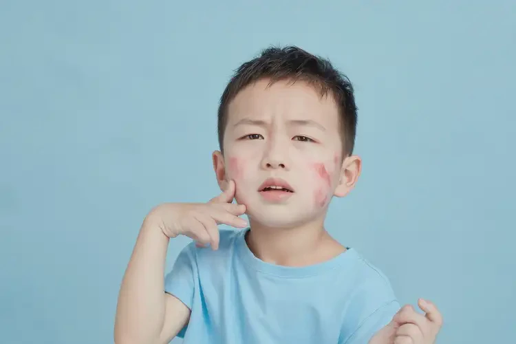 兒童屁股偶爾起濕疹可不可以根治(圖4)