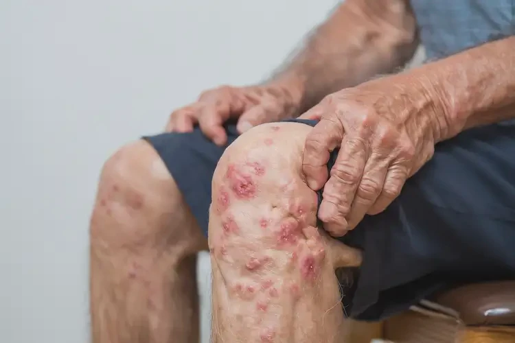 老年人小腿容易起濕疹可不可以根治(圖4)