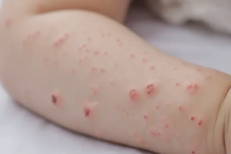 幼兒手臂上經(jīng)常起濕疹可不可以根治(圖4)