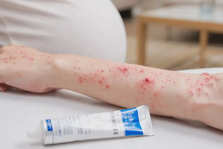 孕妇手臂上经常长湿疹不管它会自己痊愈吗(图4)