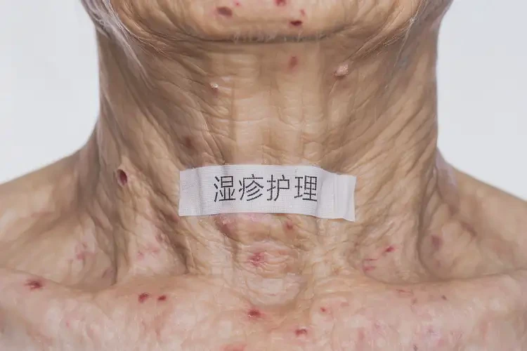 老年人脖子上容易长湿疹可不可以根治(图4)