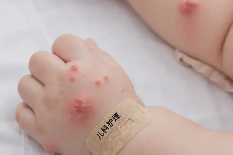 嬰兒手臂長濕疹可以治好嗎(圖4)
