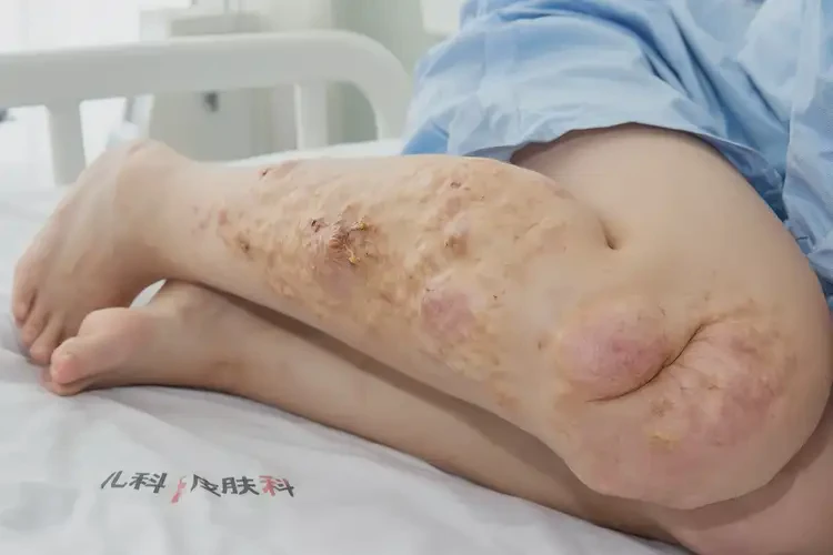 孩子大腿起濕疹可不可以根治(圖3)