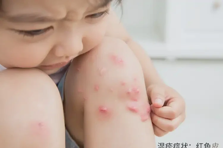 孩子大腿偶爾長濕疹可以治好嗎(圖4)