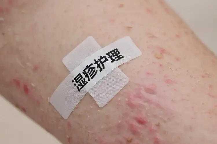 少兒全身起濕疹可不可以徹底自愈(圖4)