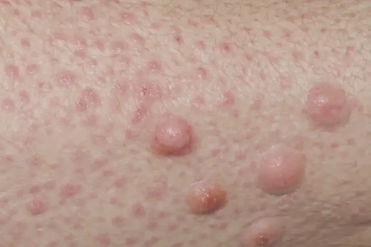 老年人肛周经常长湿疹可不可以根治(图4)