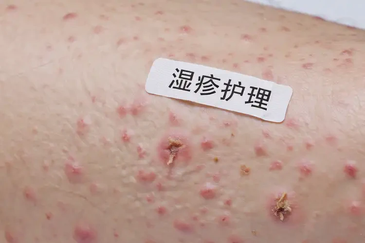 老年人小腿经常起湿疹可不可以根治(图4)