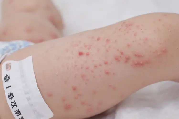 新生兒大腿上偶爾起濕疹可不可以根治(圖4)