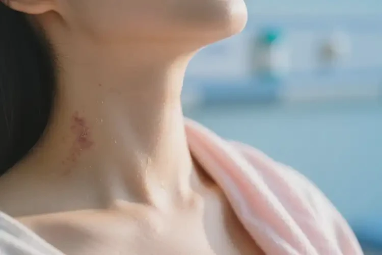 產(chǎn)婦脖子上容易長濕疹可不可以根治(圖3)